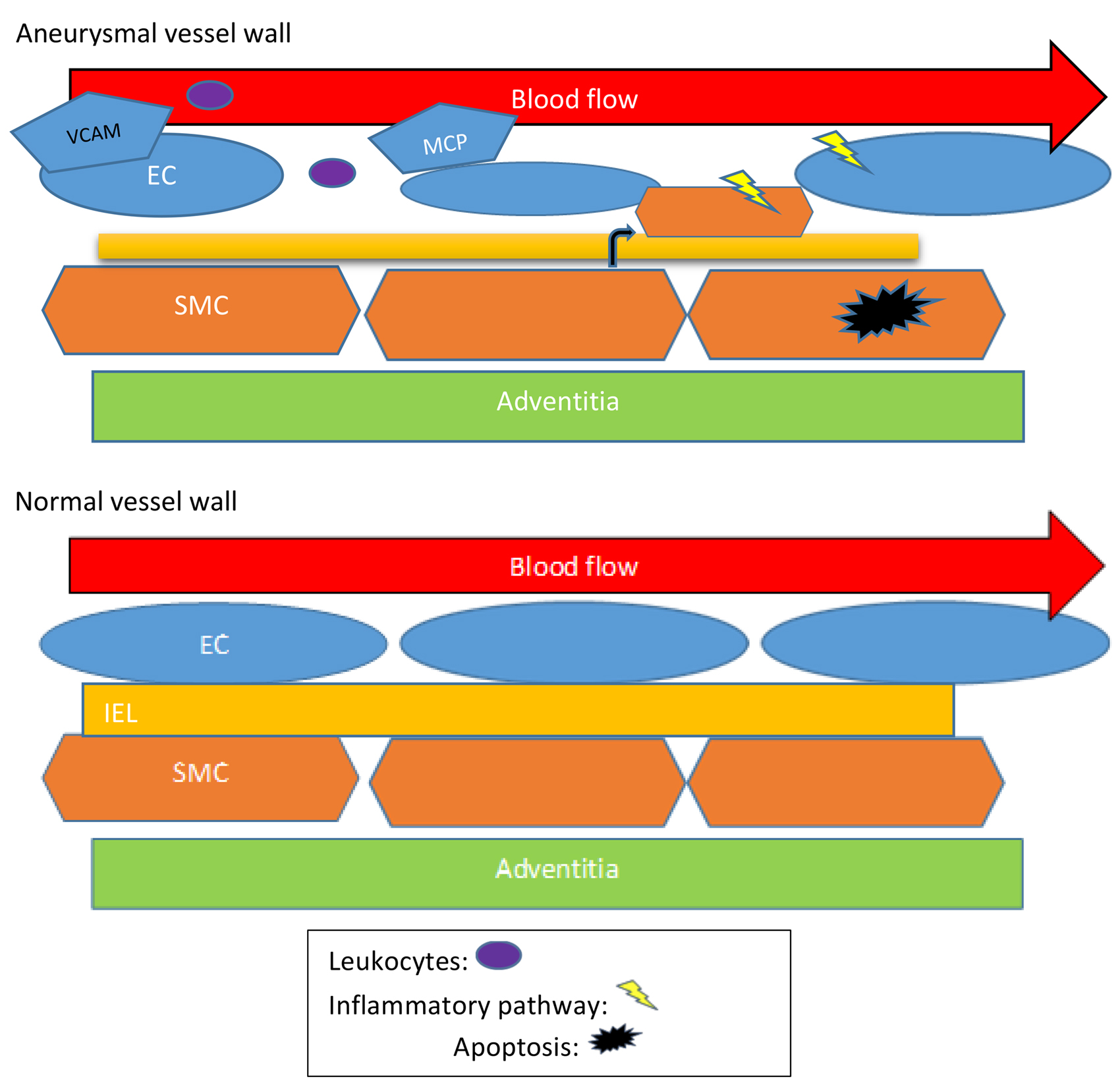 剪切應力與動脈瘤：綜述